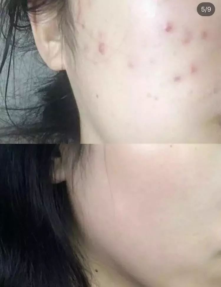 男生螨虫脸特征,螨虫脸的特征