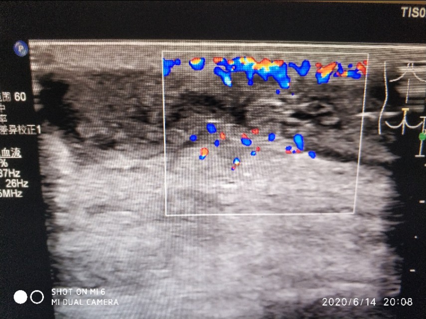 骶尾部硬包就是藏毛窦吗,骶尾骨藏毛窦和囊肿区别