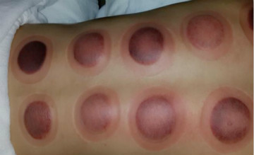 真空罐拔罐正确方法,火罐的正确拔罐方法图解