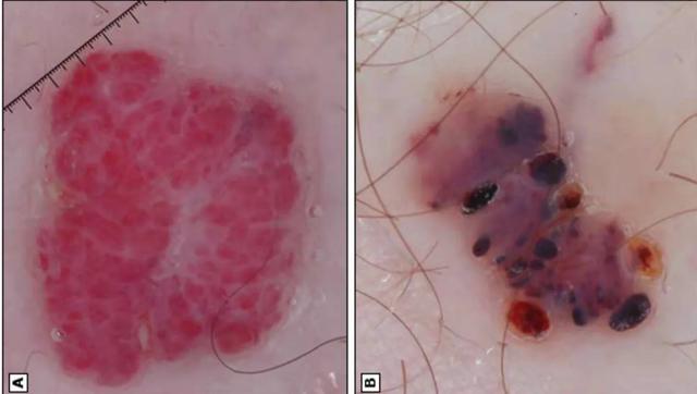 得了乙肝的人身上长红点怎么回事,乙肝病毒携带者身上有一颗颗红点