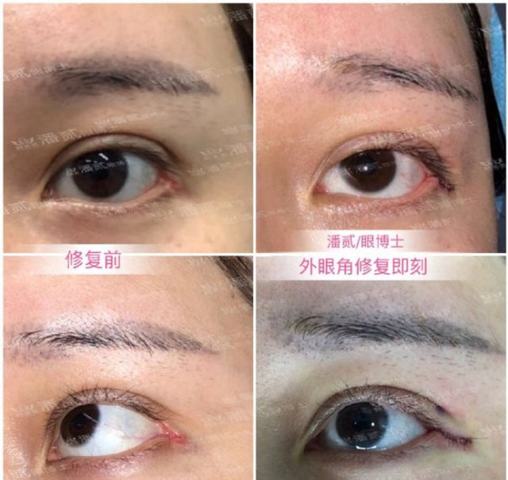 开外眼角结膜充血水肿怎么办,眼睛开外眼角有后遗症吗