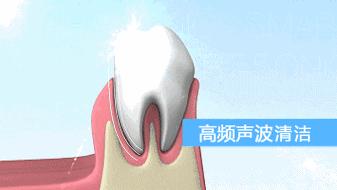 每秒振动1.5万次以下,一分钟震动10万次的牙刷