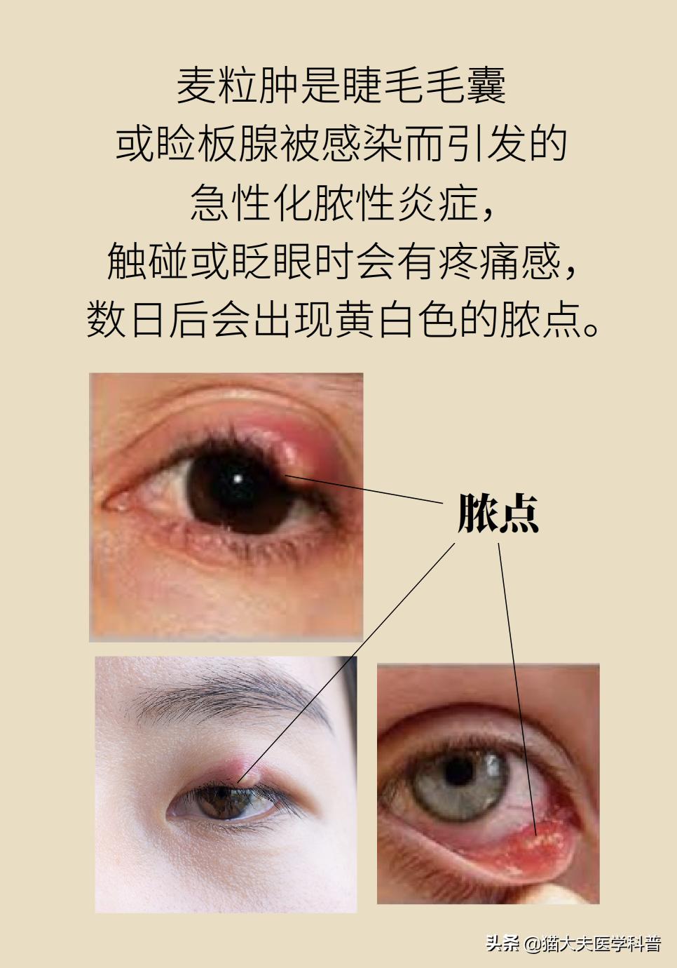 爱长针眼怎么回事,爱长针眼咋整