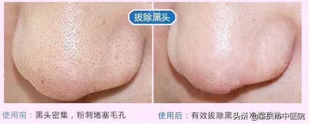 春夏之交，黑头来袭？这才是正确祛除黑头的打开方式！