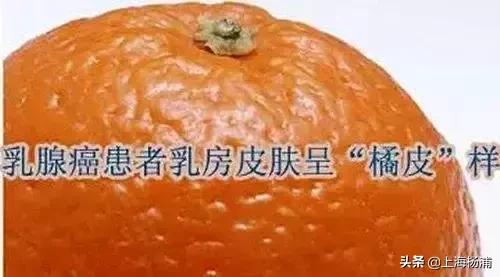 健康宣教乳腺癌,健康科普临床试验乳腺癌