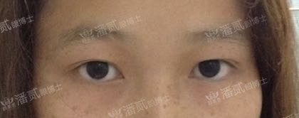 开眼角手术如何避免回缩,开眼角手术常见问题及解决方法