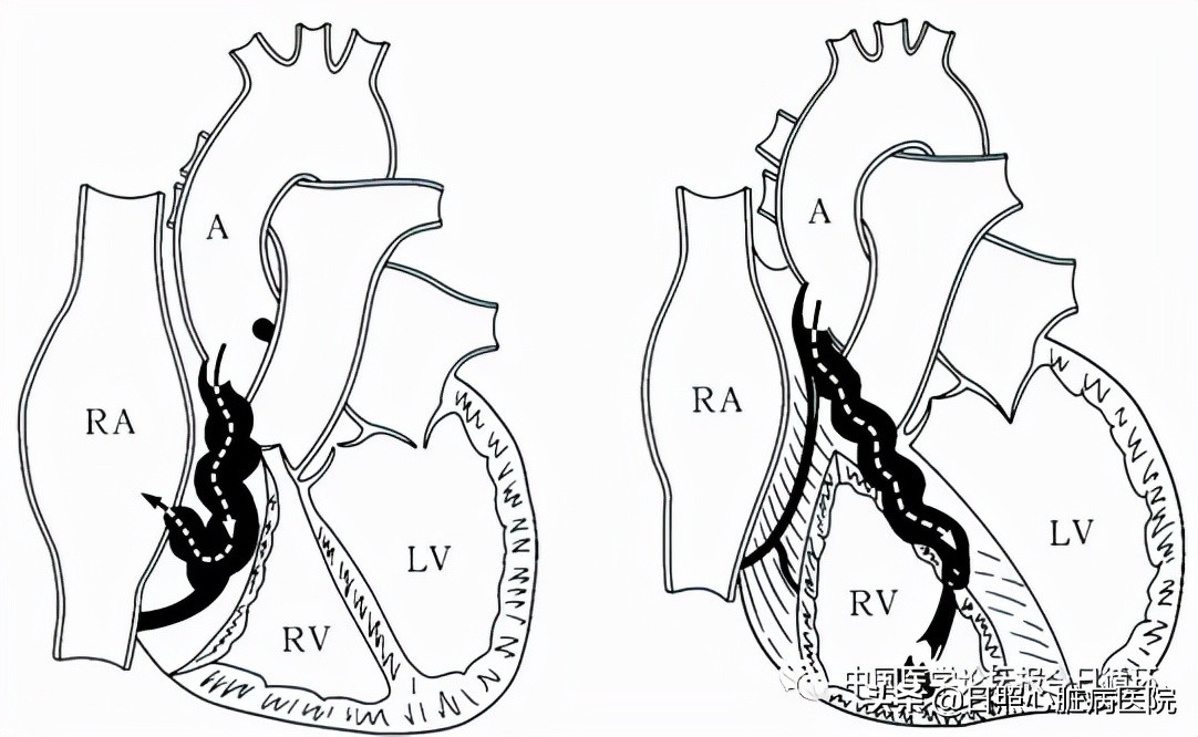 冠状动脉瘘能活多久,冠状动脉瘘彩超表现