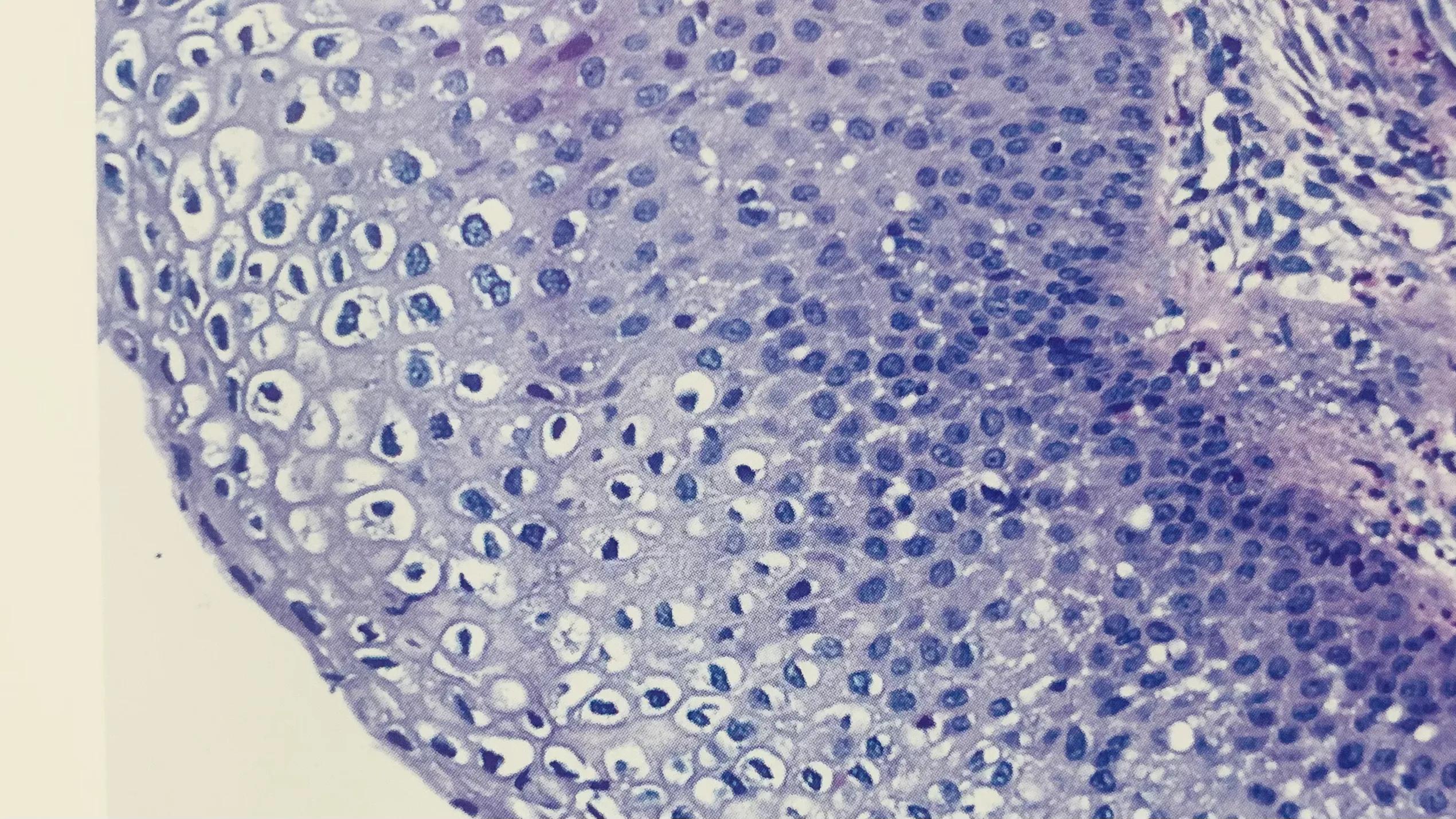 hpv感染可以打四价吗,hpv感染可以吃中药吗