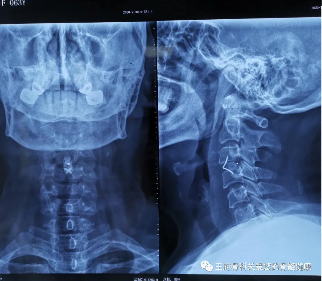 常见的五种颈椎病,颈椎病并发症最容易忽略的症状
