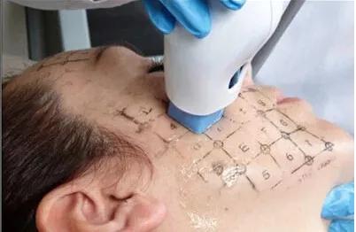 医美收毛孔价格表,医美收毛孔什么方法好