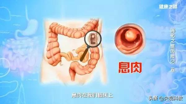 肠道安全检查!遇上肠息肉、结直肠癌……怎么办?