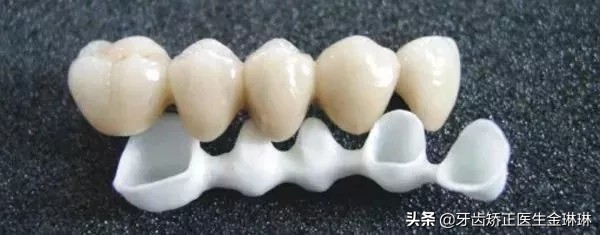 天津后槽牙种植一颗多少钱,后槽牙掉了四颗需要多少钱