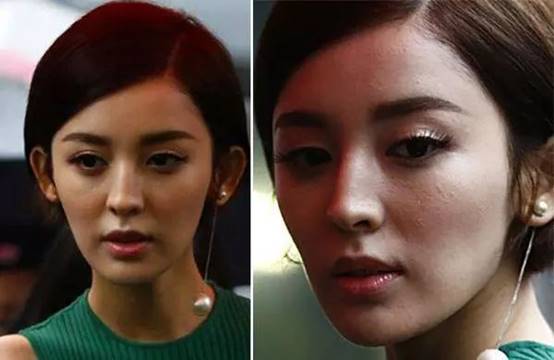 女生闭口痘痘怎么处理好得快,女生脸上有闭口痘痘怎么解决