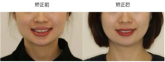 深覆盖vs深覆合,深覆盖和深覆合哪个难度大