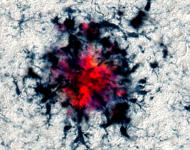 阿尔茨海默症淀粉样蛋白能降解吗,淀粉和阿尔茨海默病的关系