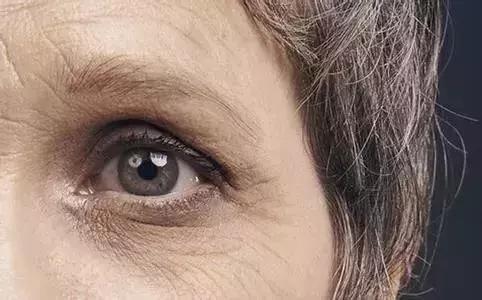 线雕5年后的变化图片,做了线雕以后的注意事项