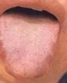 老中医舌苔从厚变薄了,任博士老中医讲舌苔