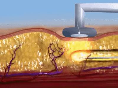 25岁抗老拯救垮脸,哪种脸型抗衰抗皱
