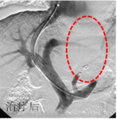 举例科普|介入能治疗哪些疾病?