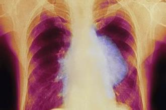 肺癌恶性胸水预后,肺癌有胸水咳嗽用药