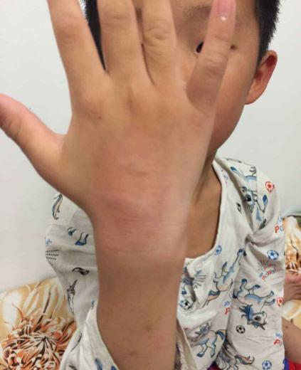 宝宝被门夹擦什么快好,婴儿被门夹伤该怎么办