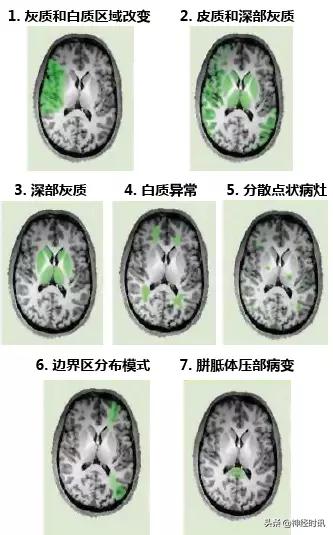 脑卒中病历诊断书图片,脑卒中影像判断技巧图解电子版