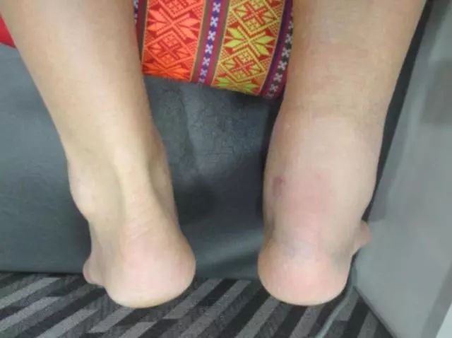 跟腱断裂和前叉损伤,前叉断裂和跟腱断裂哪个严重