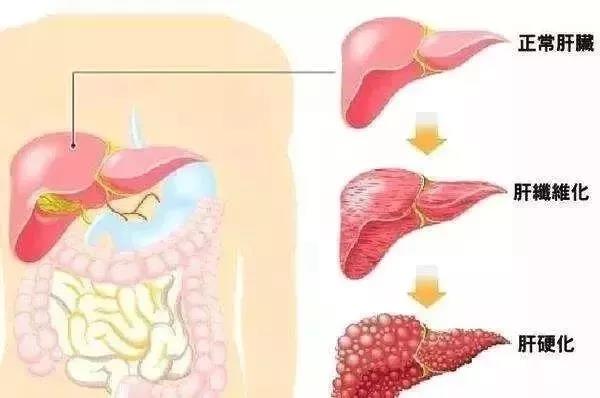 间充质干细胞能治肝纤维化吗,干细胞治疗肝硬化的最新研究