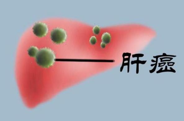 解读肝癌外科治疗中的重要问题,关于肝癌介入治疗的常见疑惑