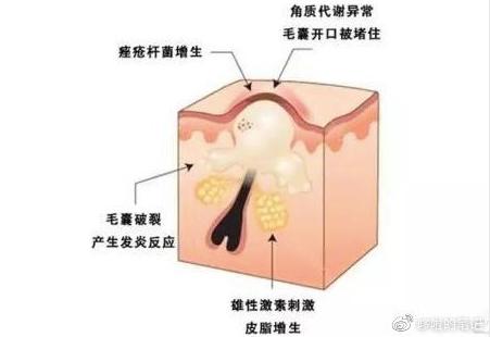 祛痘教材,教学祛痘