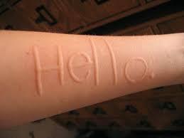 人工荨麻疹皮肤划痕症怎么治,人工荨麻疹皮肤划痕症怎么治疗