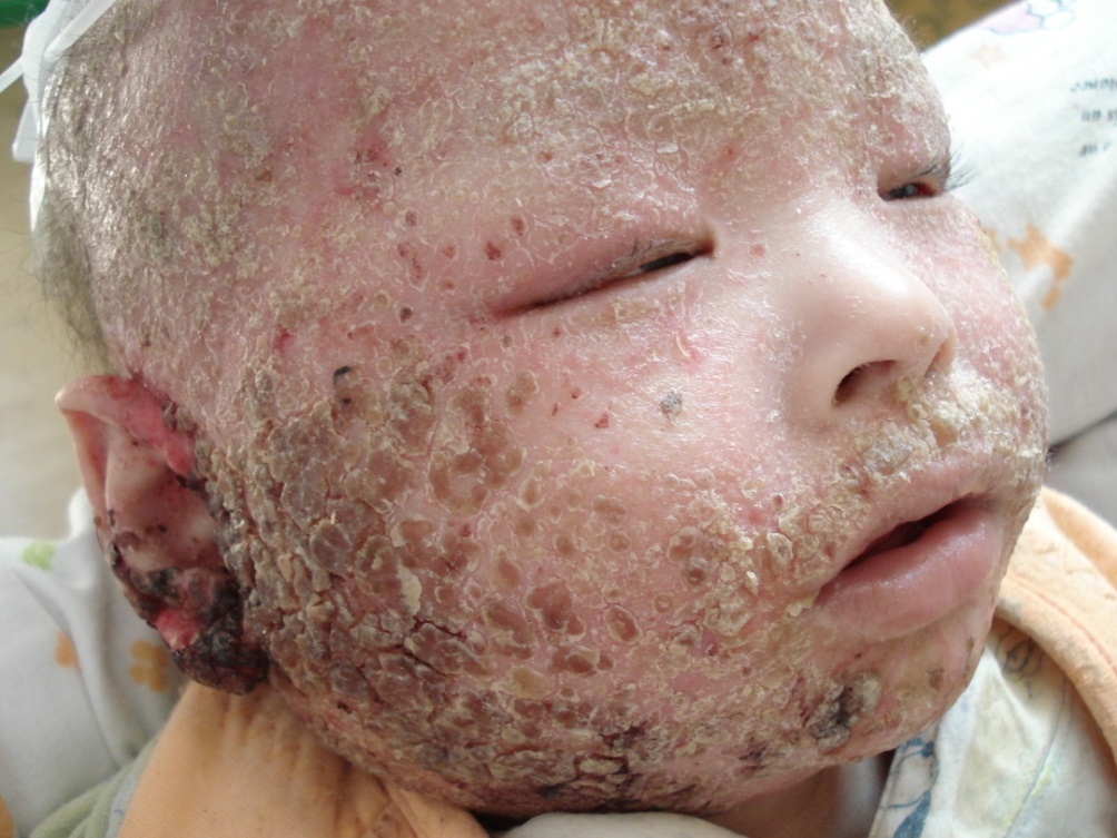 宝宝湿疹反复怎么办教你一招去除,宝宝的湿疹一直反复发作怎么办