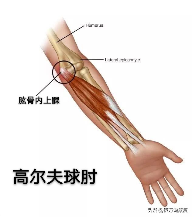 高尔夫球肘关节疼痛治疗,急性高尔夫球肘快速康复方法