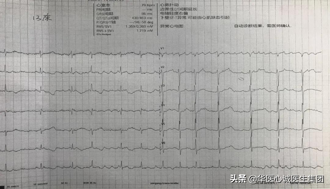 窦性心动过速查房,攀钢集团总医院心内科