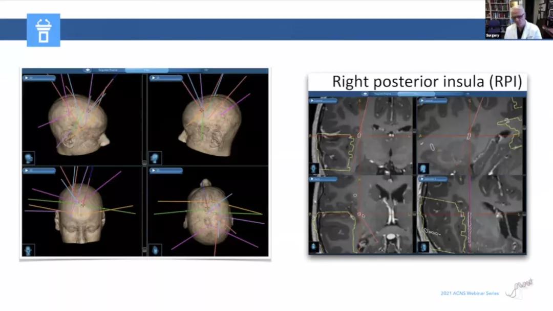 儿童癫痫治愈的真实案例,儿童难治性癫痫有哪些
