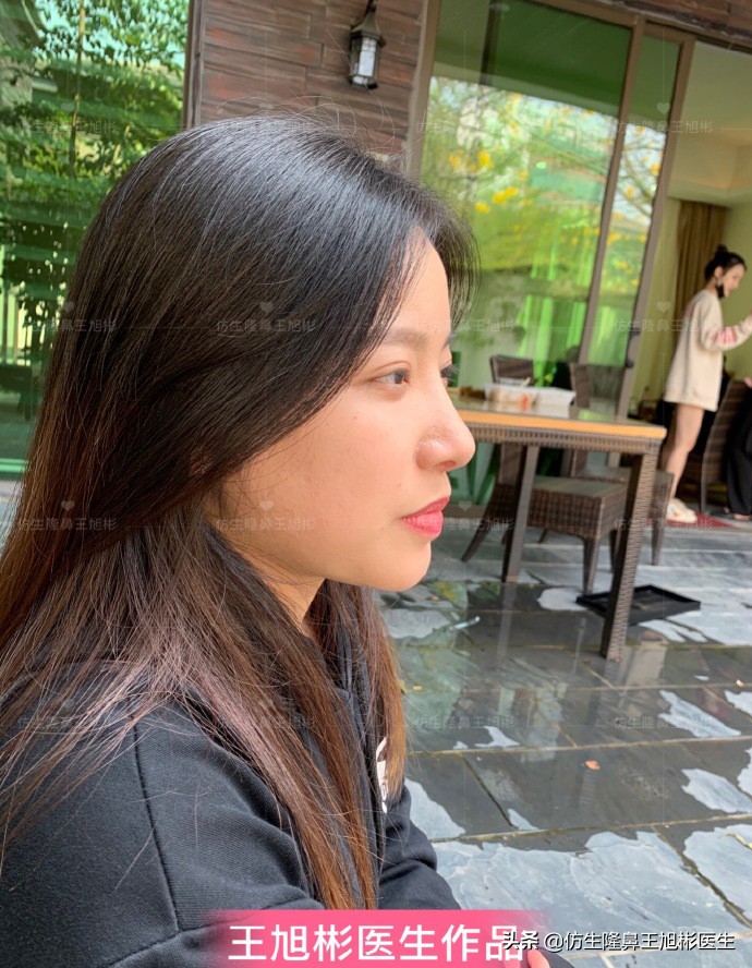 手术鼻头增厚能用什么方法弄,大鼻头高鼻梁缩小手术案例