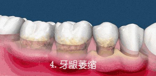 小孩口臭长出的新牙也黄,口臭牙黄怎么办学生党