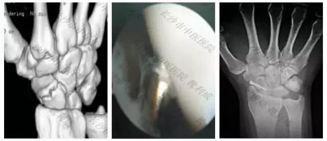 腱鞘囊肿除了手术还有什么办法,下颚有囊肿可以做穿刺手术
