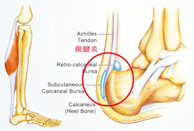 早起下床脚跟痛,早起下床脚踩地脚掌刺痛