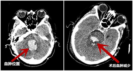 突发脑干出血机器人来救命