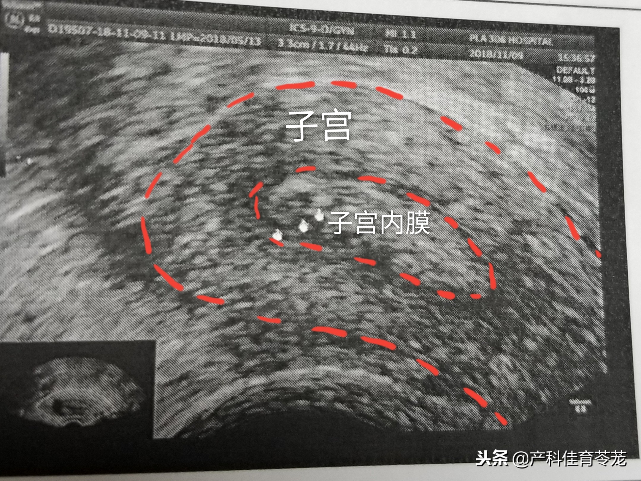 打b超能看出子宫内膜的问题吗,经腹妇科彩超分辨子宫前后位