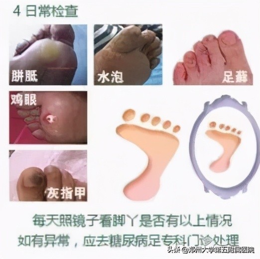 老茧疼痛怎么去除,去除手部老茧