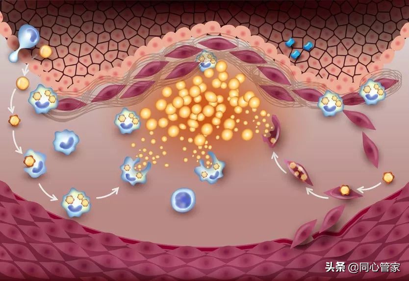 血管狭窄如何扼住生命的咽喉？让你全身器官都遭殃