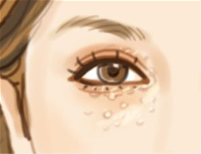 小孩眼周长扁平的疙瘩是怎么回事,眼周有小疙瘩用什么药物可以去除