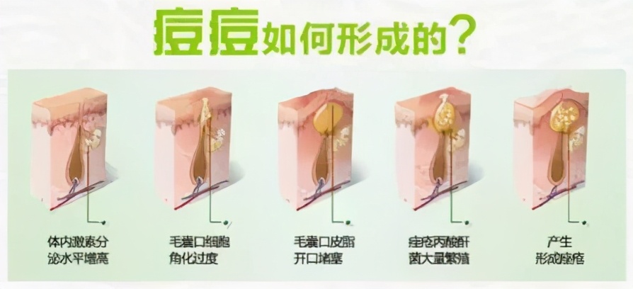 正在长痘能用水杨酸吗,还在长痘阶段能用维c精华吗