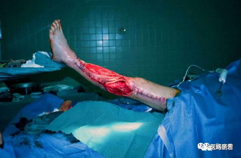 微创伤口换药步骤,如何换药包扎伤口