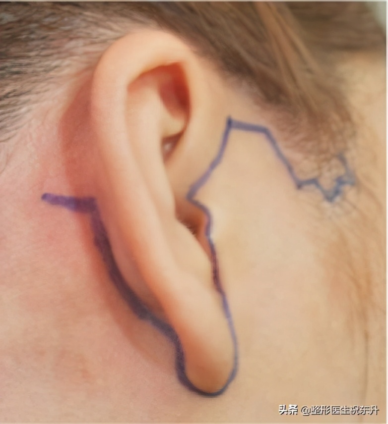 拉皮有后遗症吗会不会越老越快,50岁拉皮手术有生命危险吗