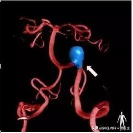 头一跳跳的疼吃什么药缓解,头一跳一跳的痛布洛芬不管用