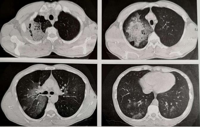 这种感染比冠状病毒更危险，还好不传染，白细胞能压制它