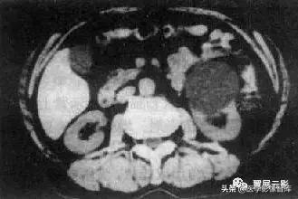 18种泌尿生殖系统常见疾病MR诊断总结